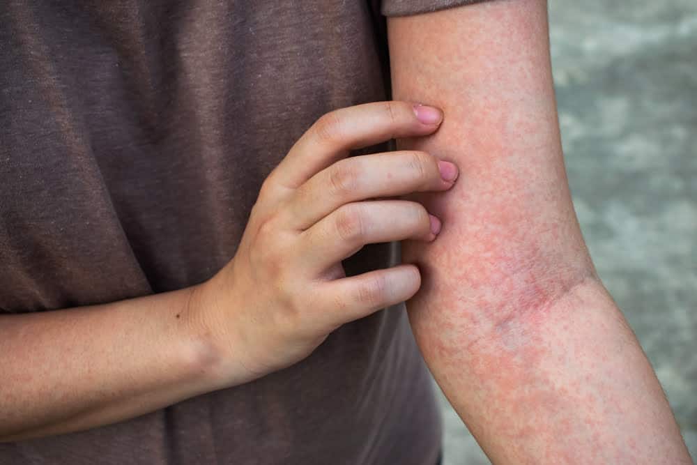 Minor Emergency Rashes
