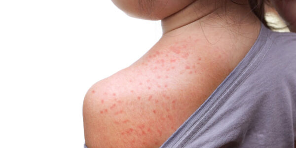 Pediatric Rashes